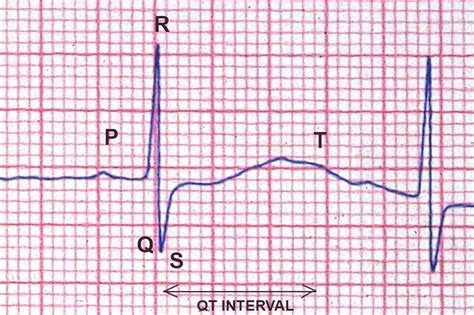 is borderline ecg dangerous|Long QT syndrome .
